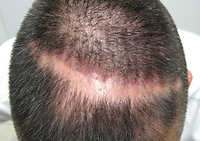 Tipo de alopecia: Alopecia Cicatricial — diagnóstico capilar FOLIMAX