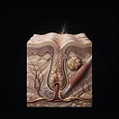 Folículo — Miniaturizado