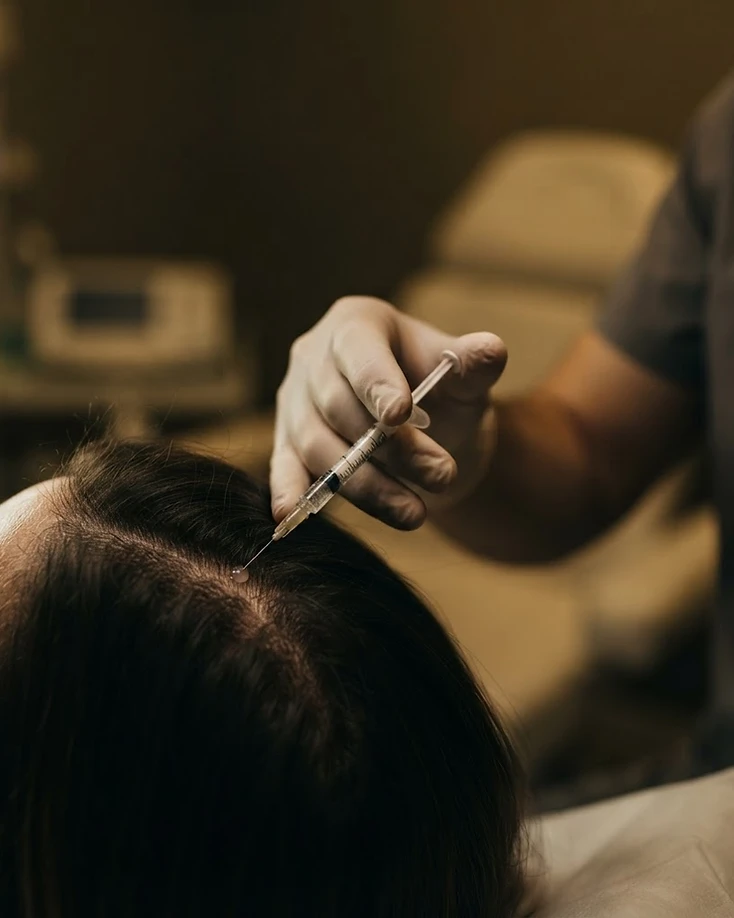 Aplicación de mesoterapia capilar en el cuero cabelludo