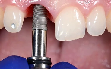 Screenshot of the Implantes Dentales en Bogotá homepage