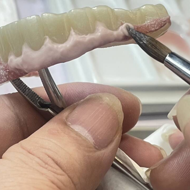 Full House Implant dental restoration