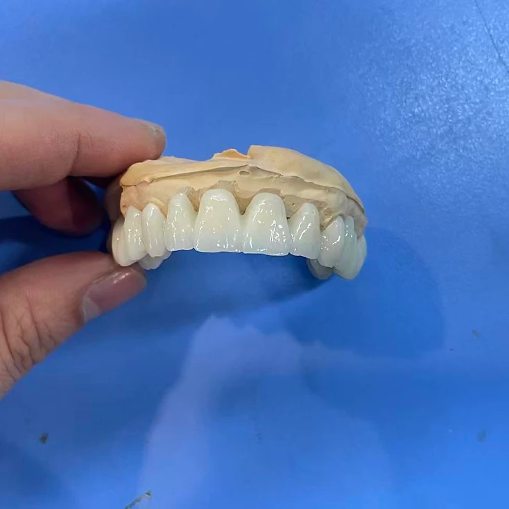 Fixed Restoration dental restoration