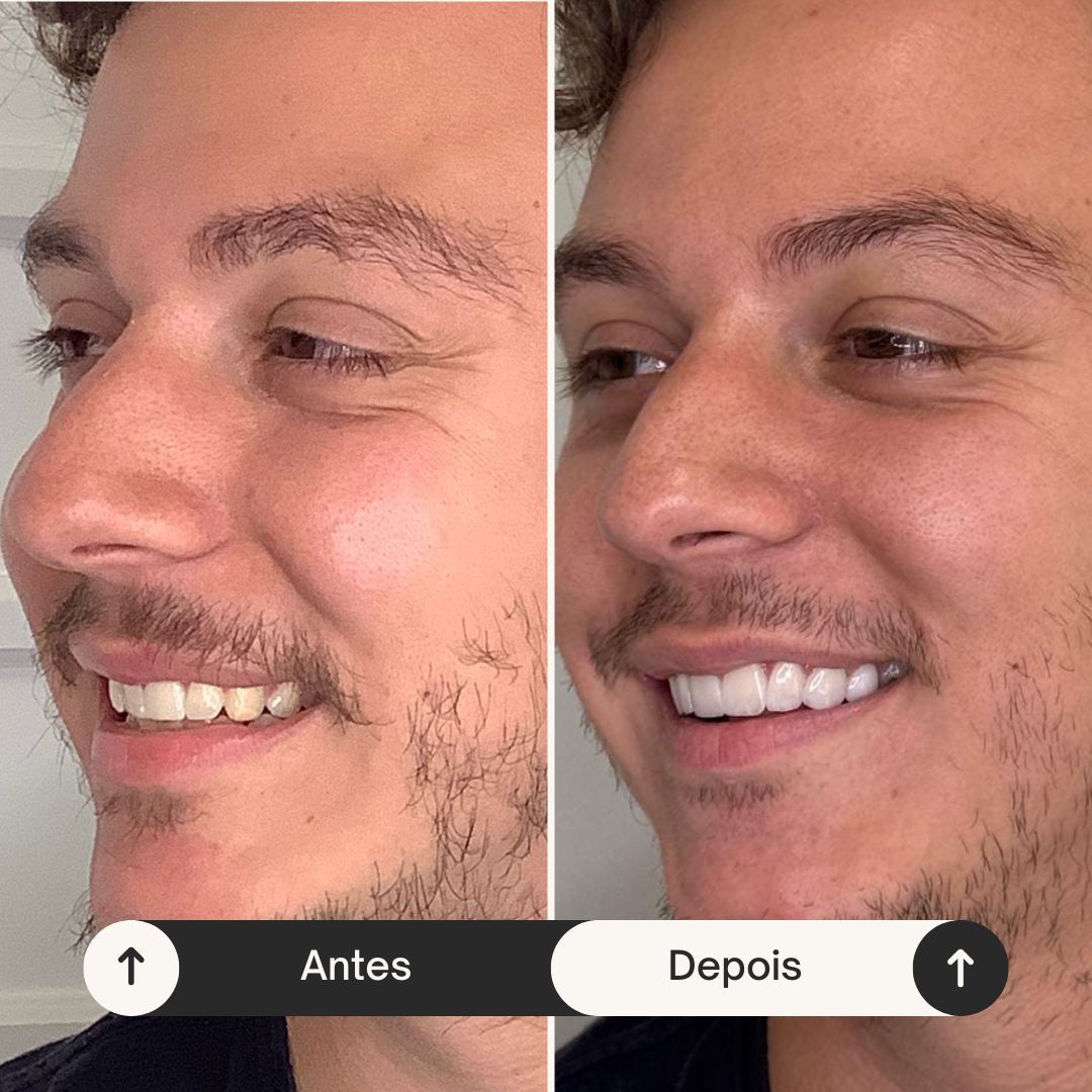 Antes e depois de reabilitação oral