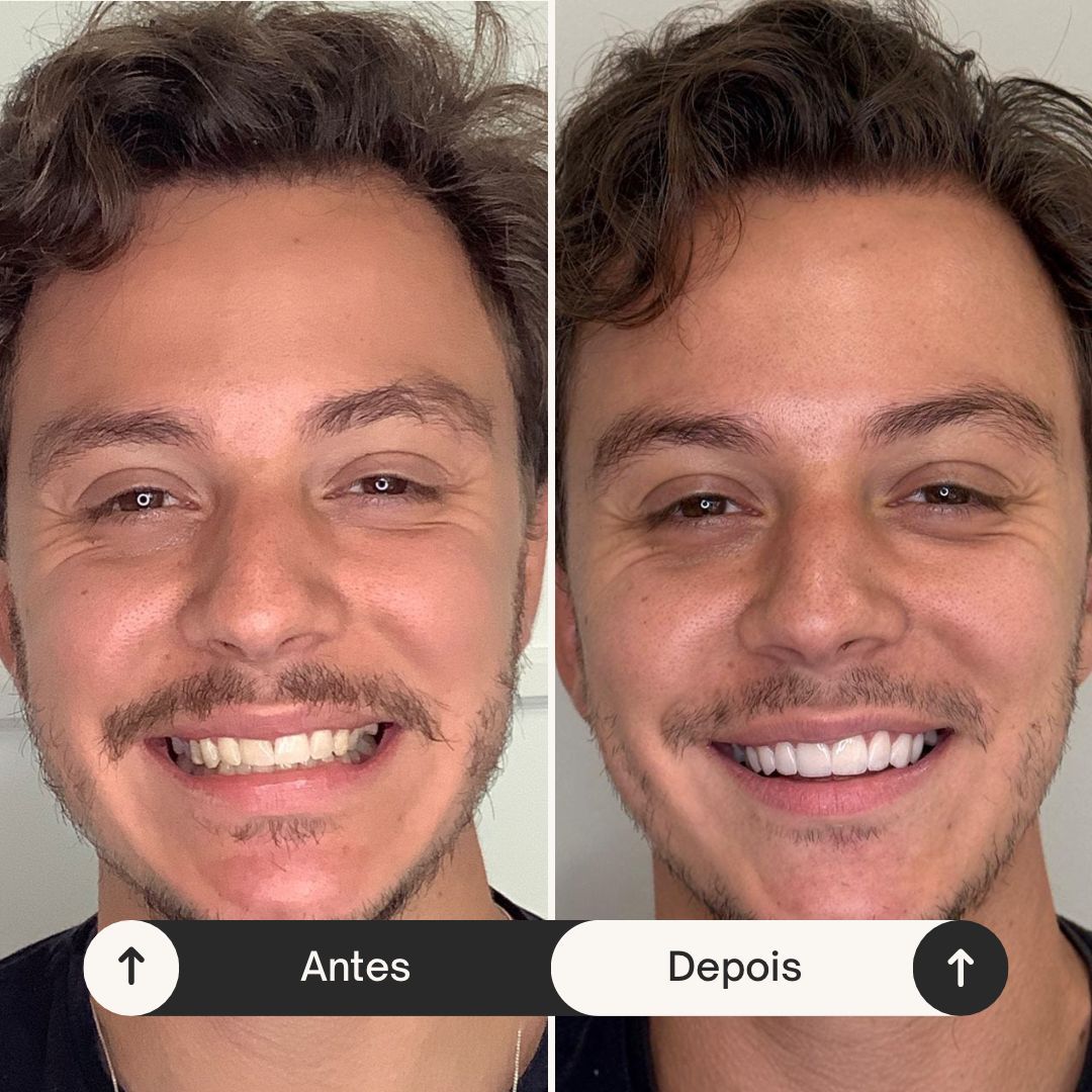 Antes e depois de reabilitação oral