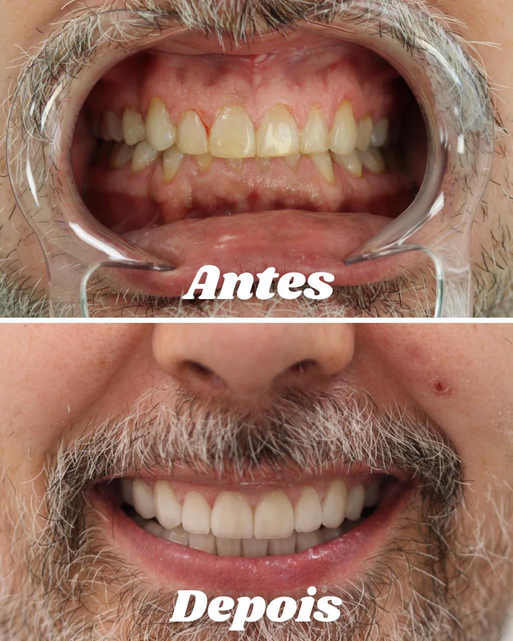 Antes e depois de reabilitação oral