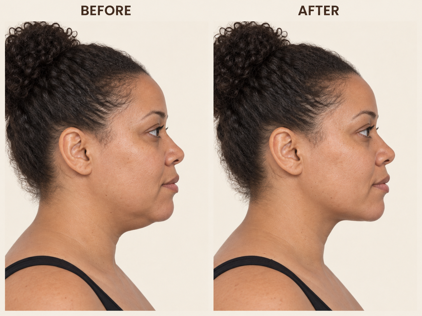 Jawline before-and-after comparison 13