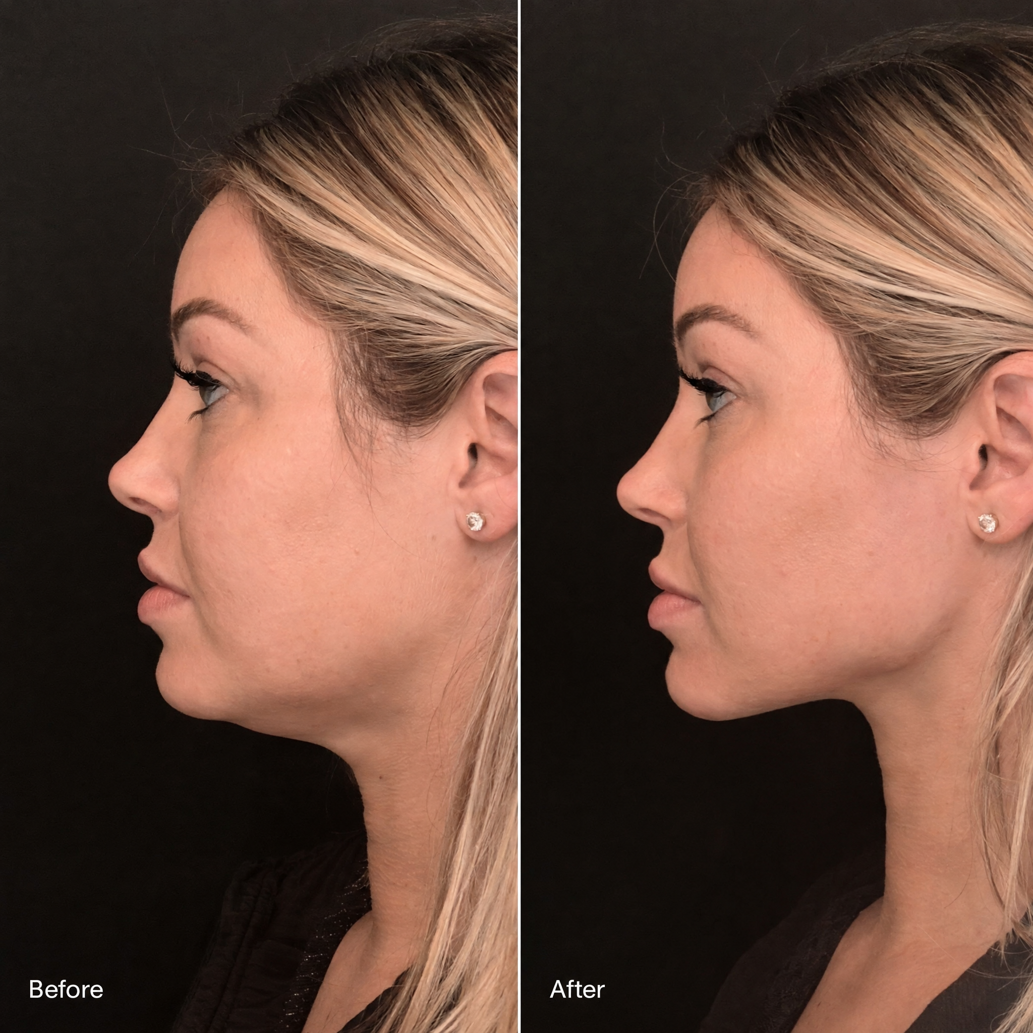 Jawline before-and-after comparison 4