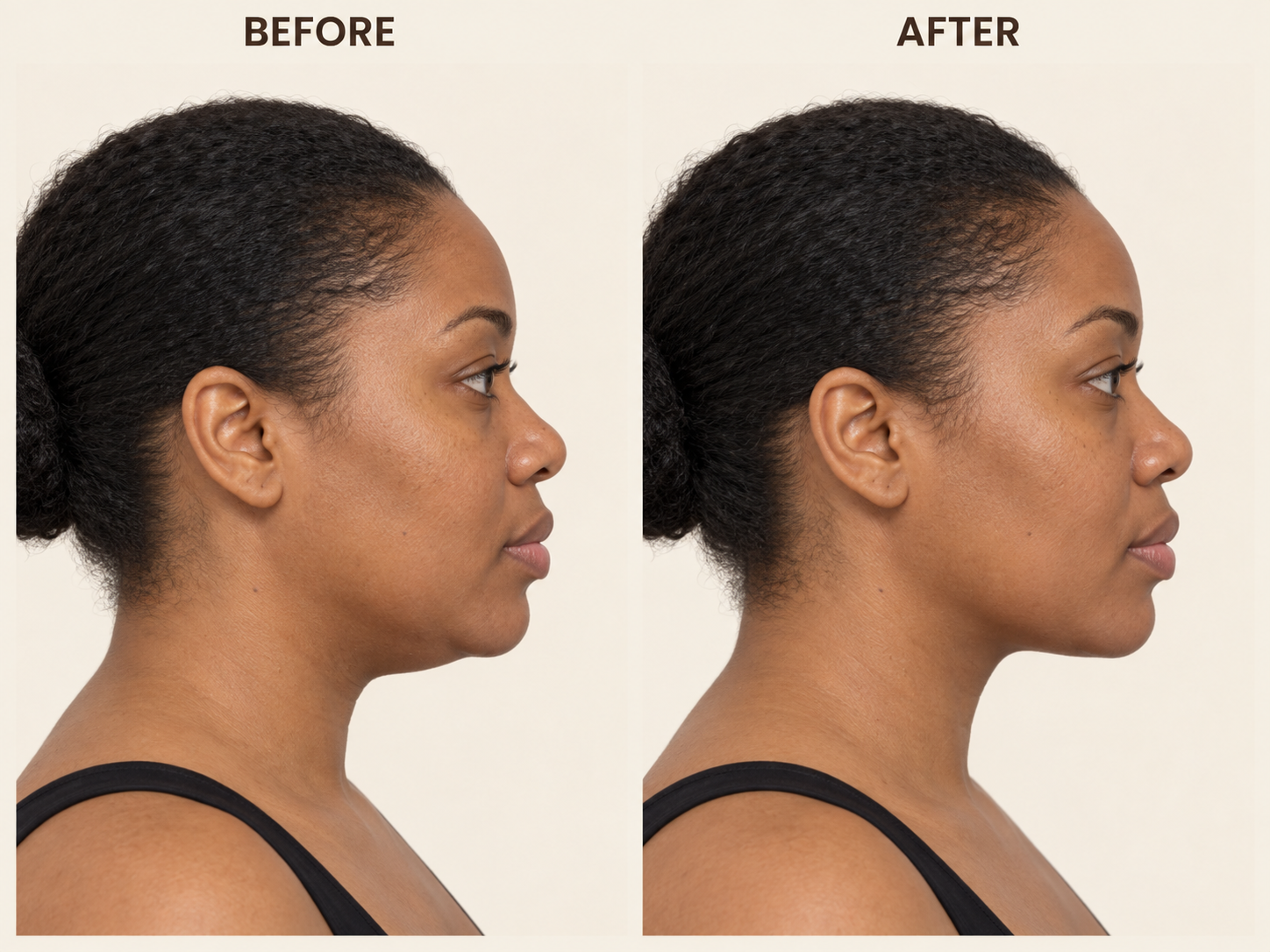 Jawline before-and-after comparison 6