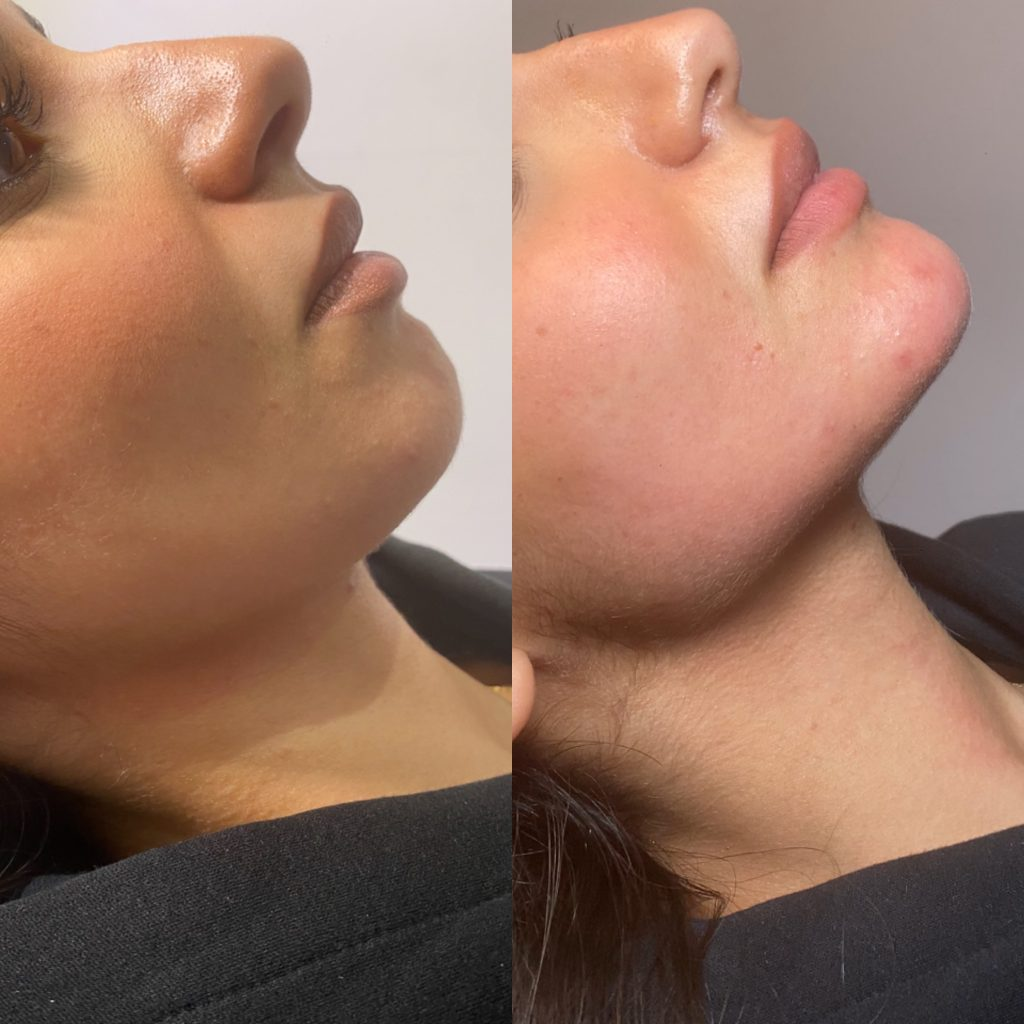 Jawline before-and-after comparison 3
