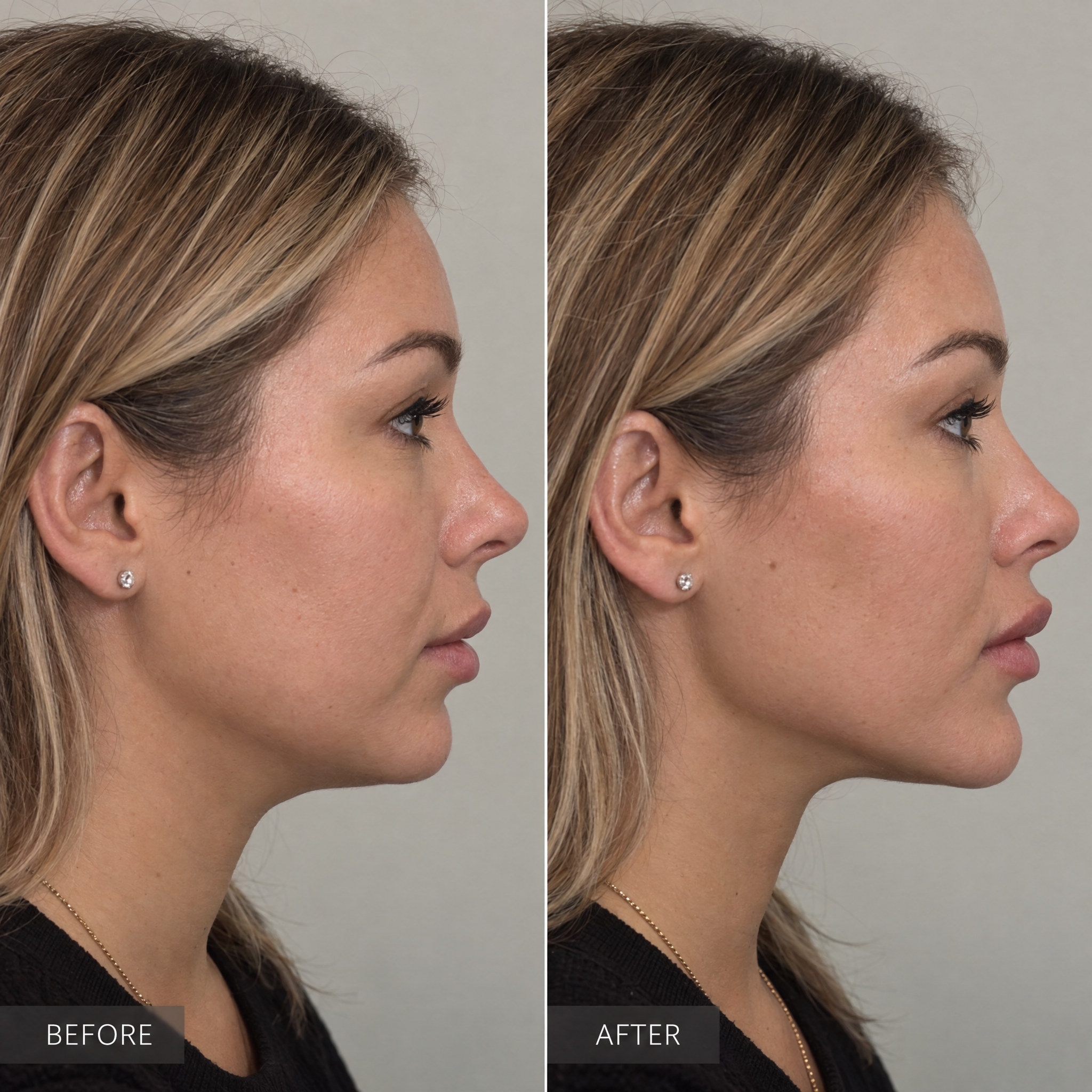 Jawline before-and-after comparison 5