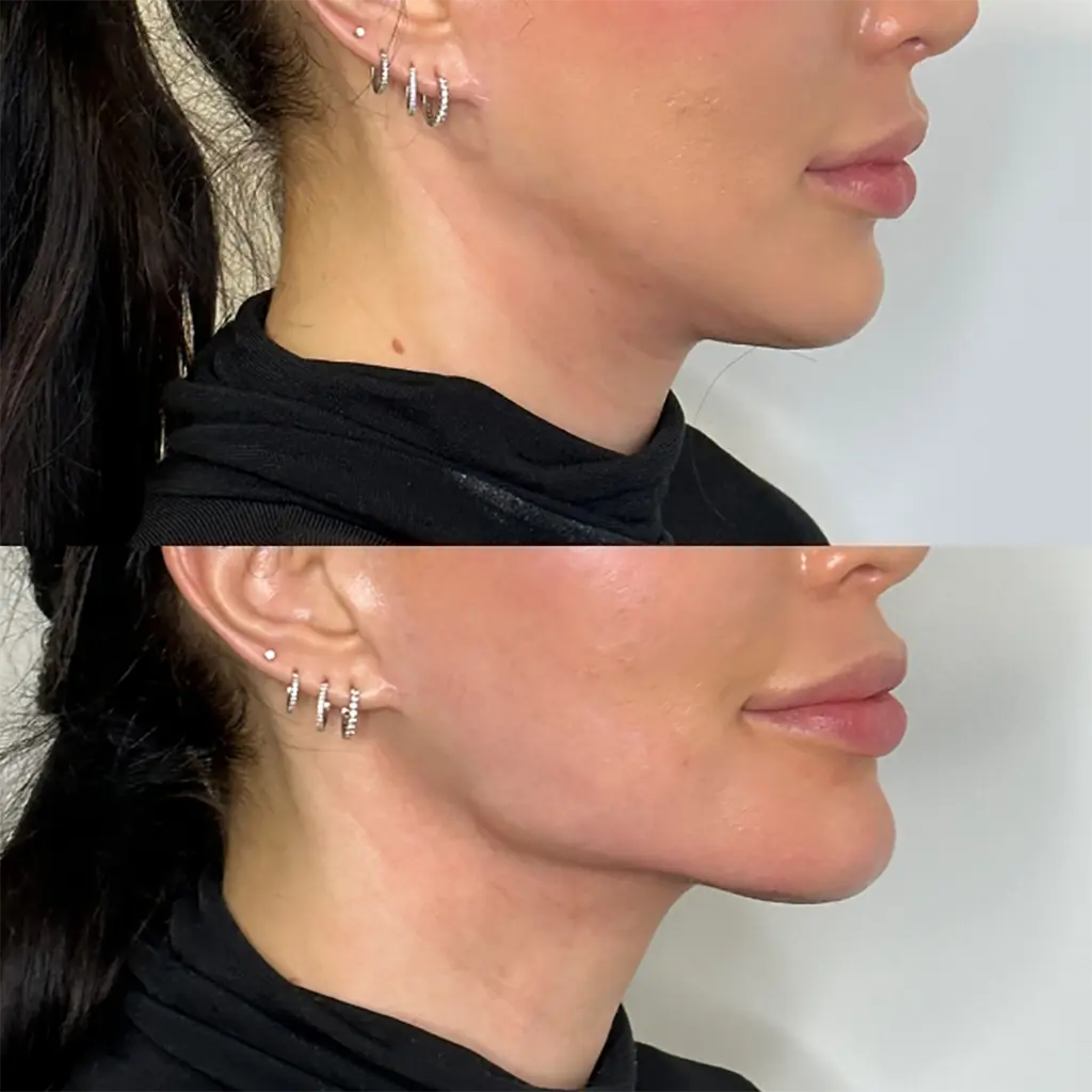 Jawline before-and-after comparison 2