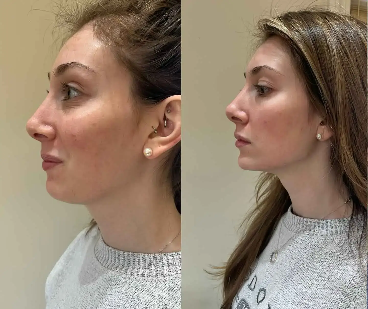 Jawline before-and-after comparison 1
