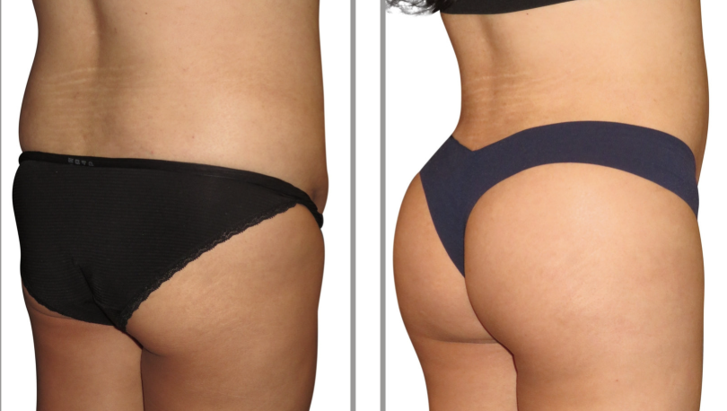 Hips & Thighs before and after