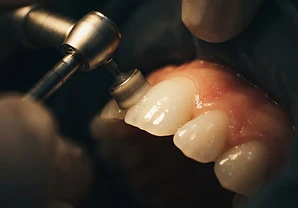 Limpieza dental