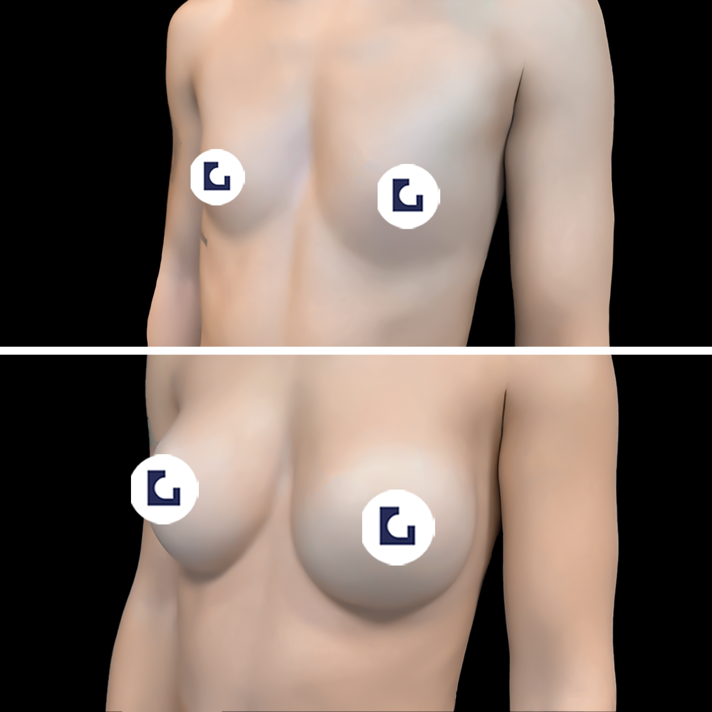 Prima e dopo mastoplastica additiva IALU BOOBS — caso 13