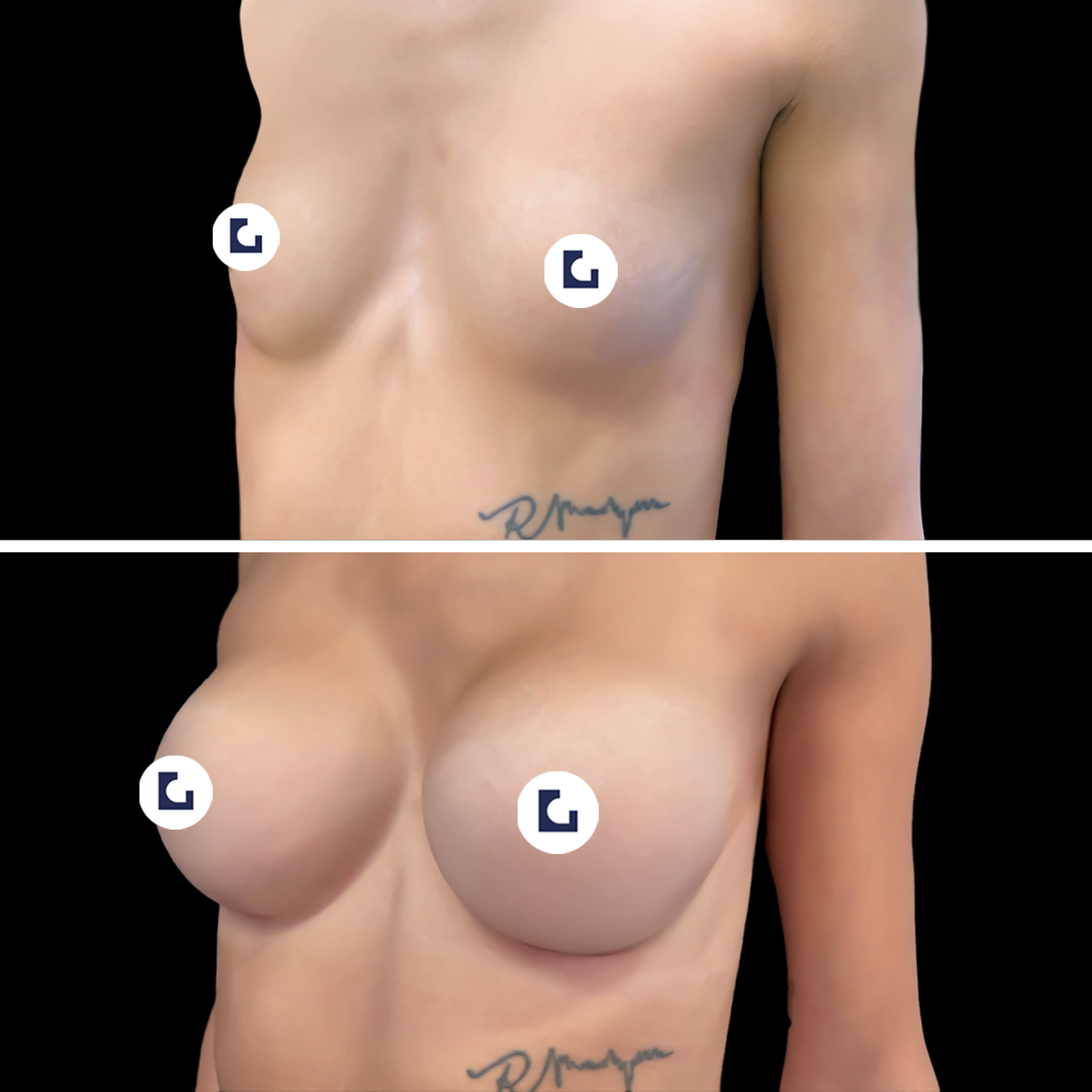 Prima e dopo mastoplastica additiva IALU BOOBS — caso 09