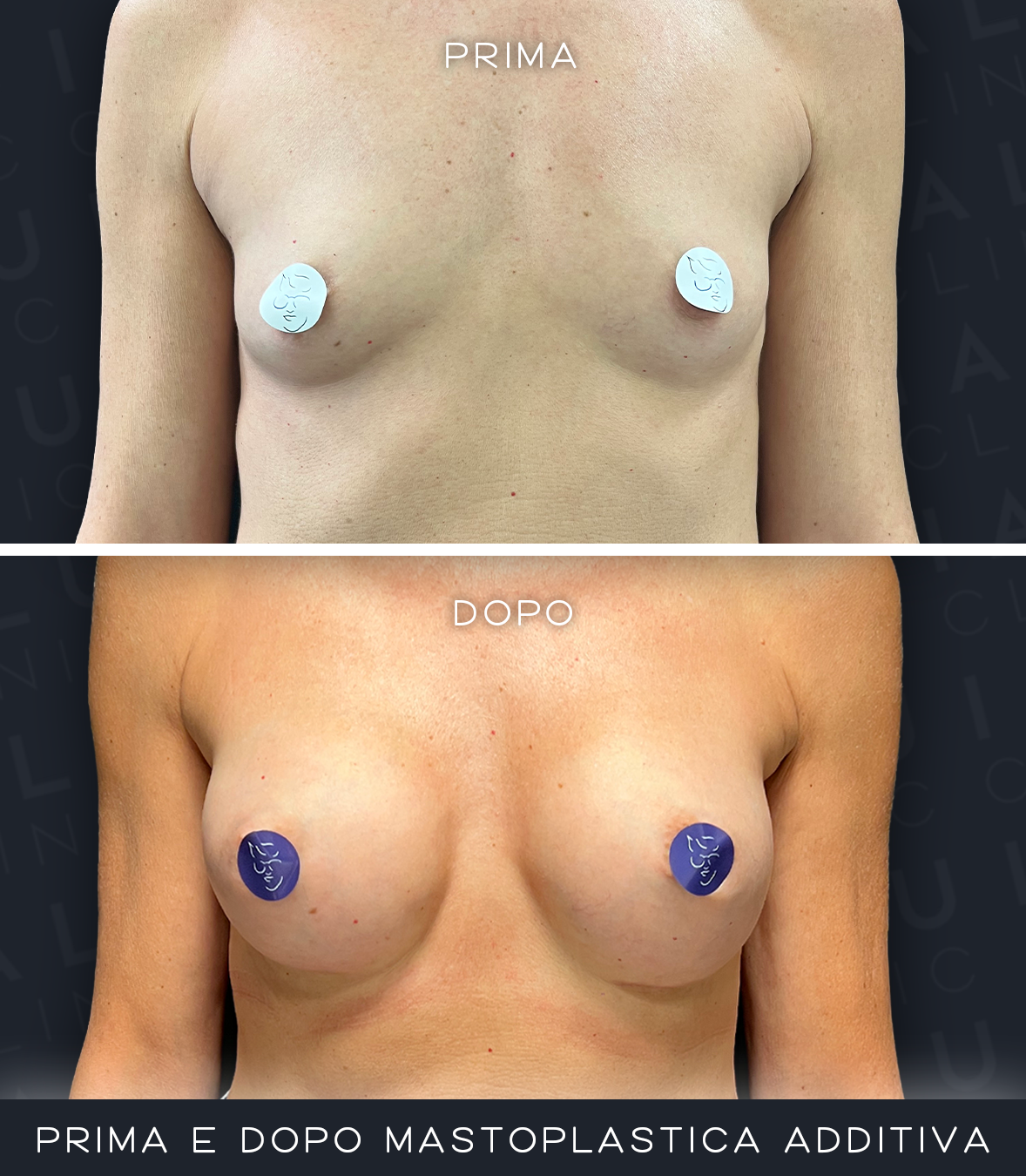 Prima e dopo mastoplastica additiva IALU BOOBS — caso 03