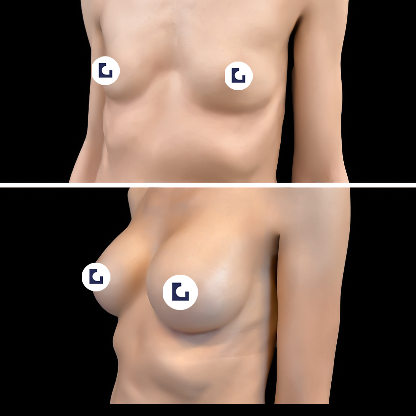 Prima e dopo mastoplastica additiva IALU BOOBS — caso 07