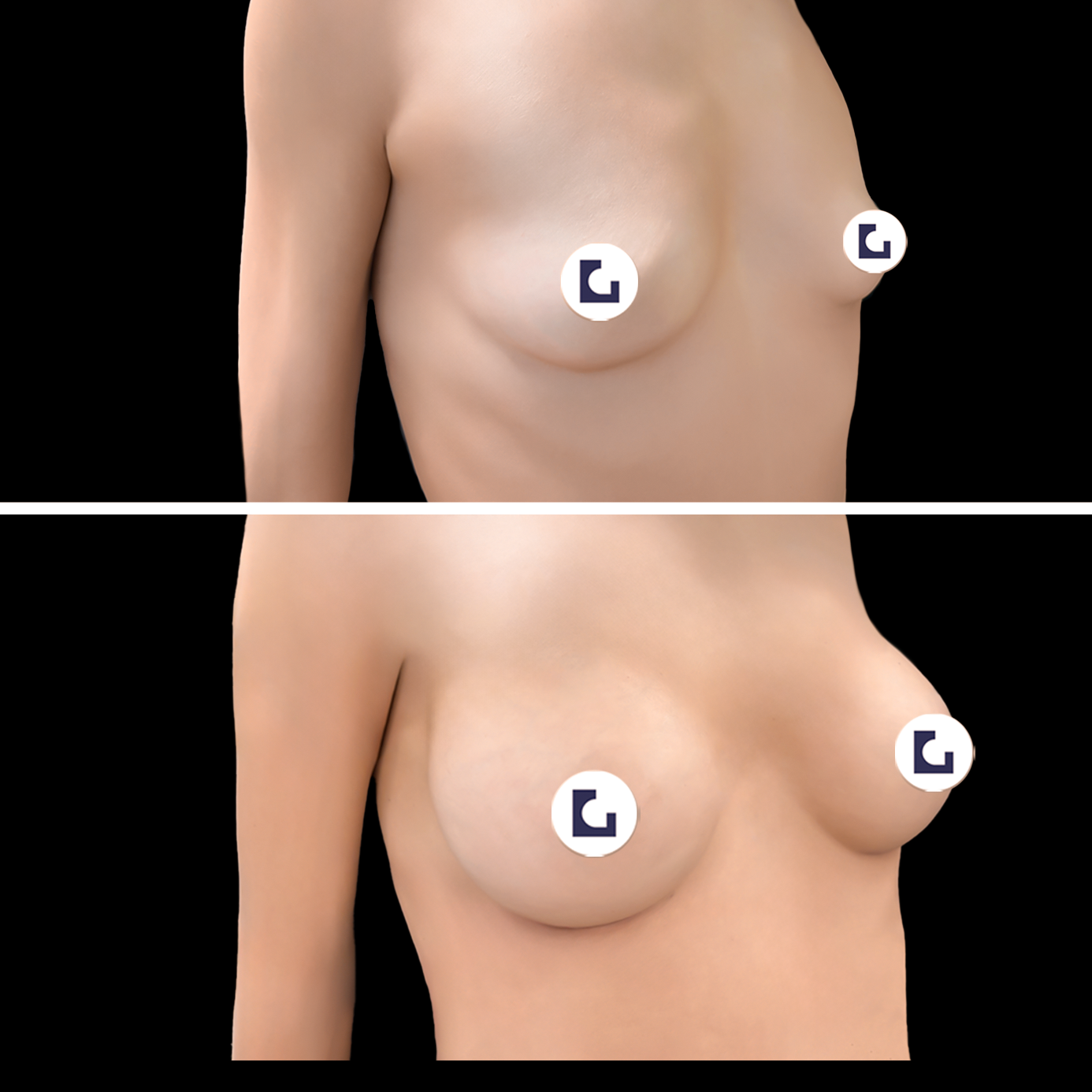Prima e dopo mastoplastica additiva IALU BOOBS — caso 04