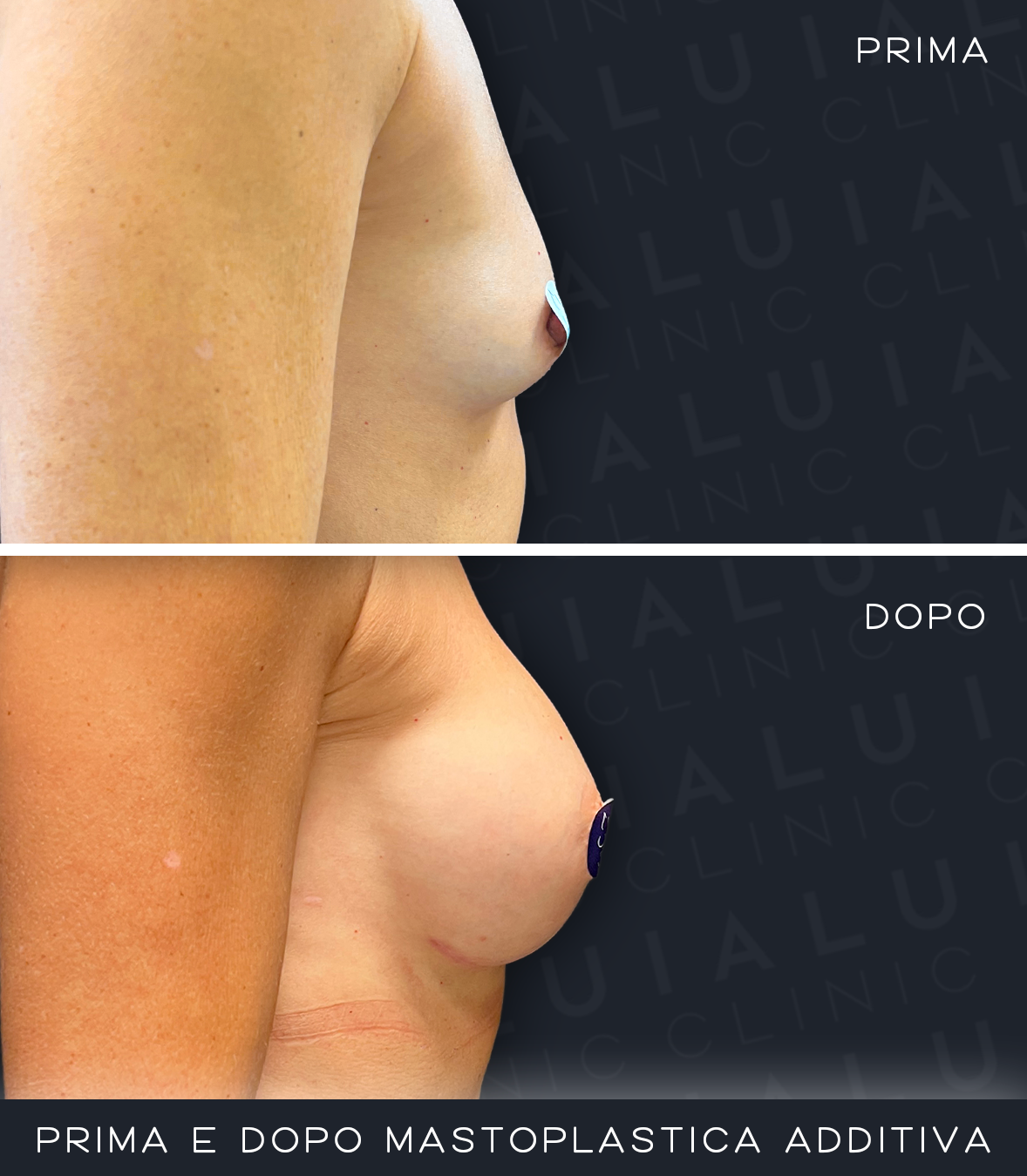 Prima e dopo mastoplastica additiva IALU BOOBS — caso 02