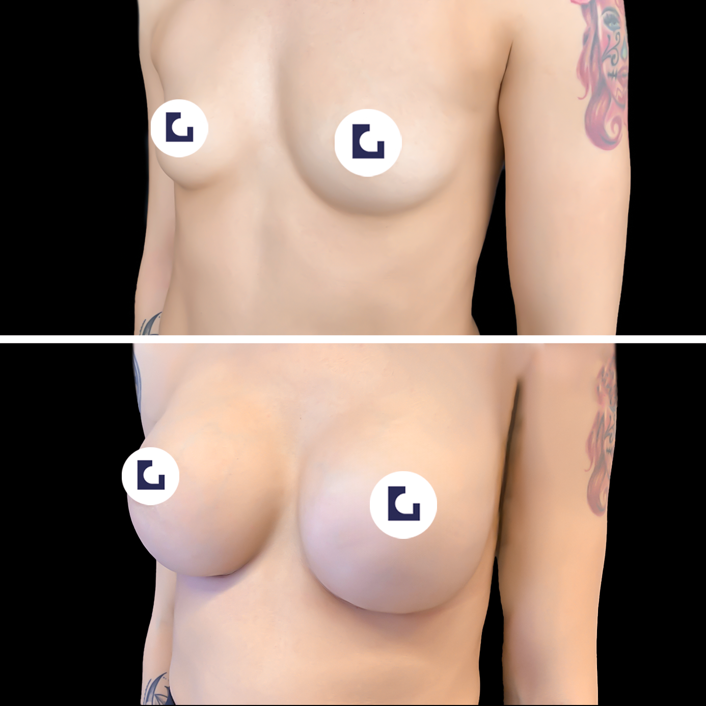 Prima e dopo mastoplastica additiva IALU BOOBS — caso 06