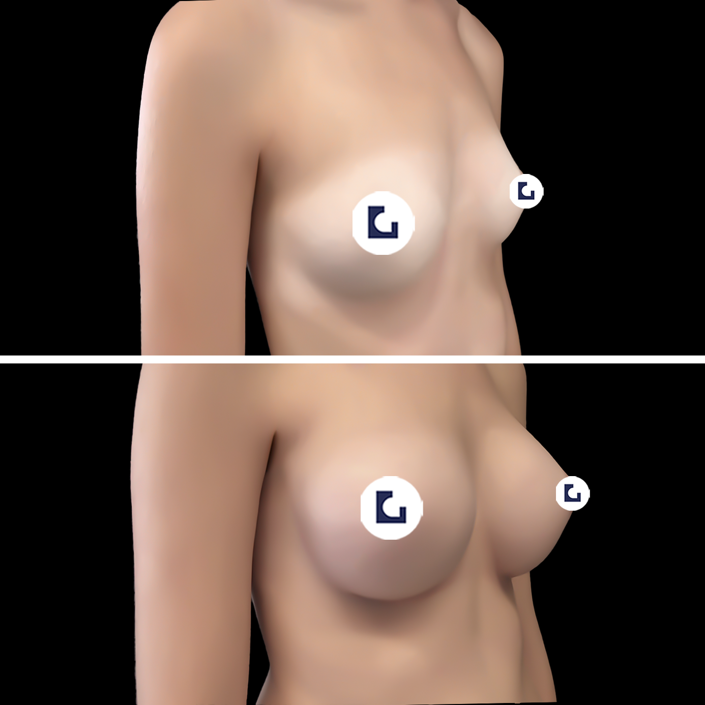 Prima e dopo mastoplastica additiva IALU BOOBS — caso 12