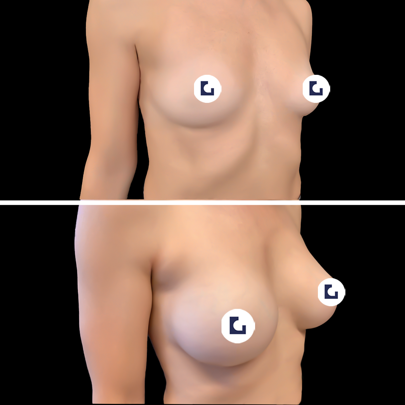 Prima e dopo mastoplastica additiva IALU BOOBS — caso 10