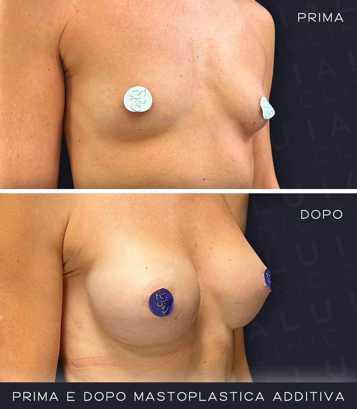 Prima e dopo mastoplastica additiva IALU BOOBS — caso 01
