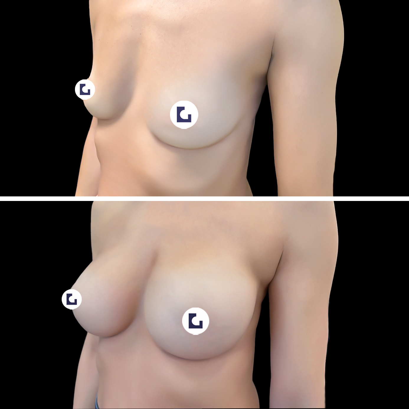 Prima e dopo mastoplastica additiva IALU BOOBS — caso 05