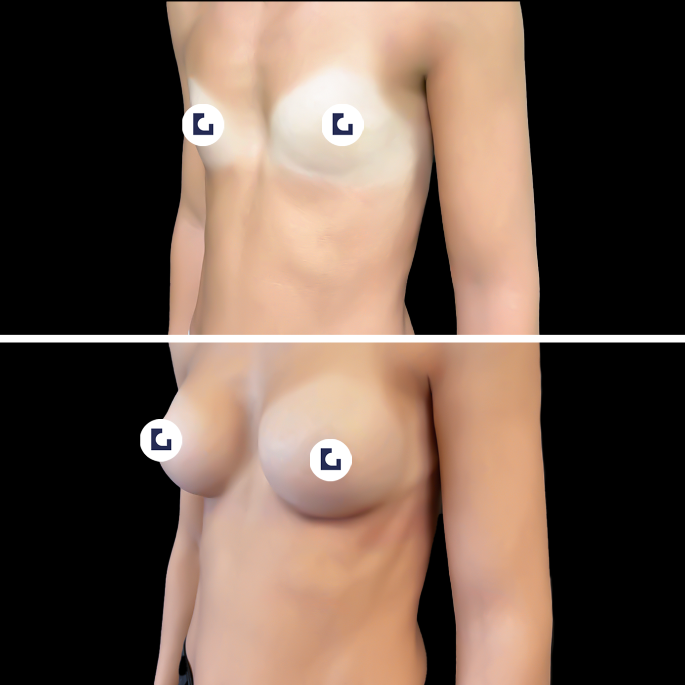 Prima e dopo mastoplastica additiva IALU BOOBS — caso 08