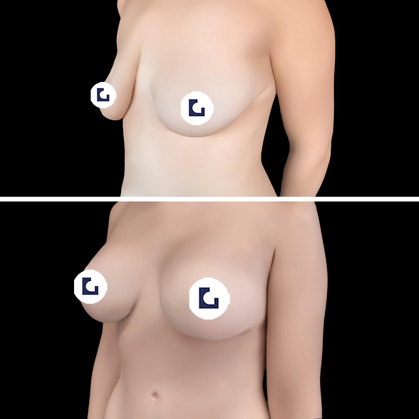 Prima e dopo mastoplastica additiva IALU BOOBS — caso 11