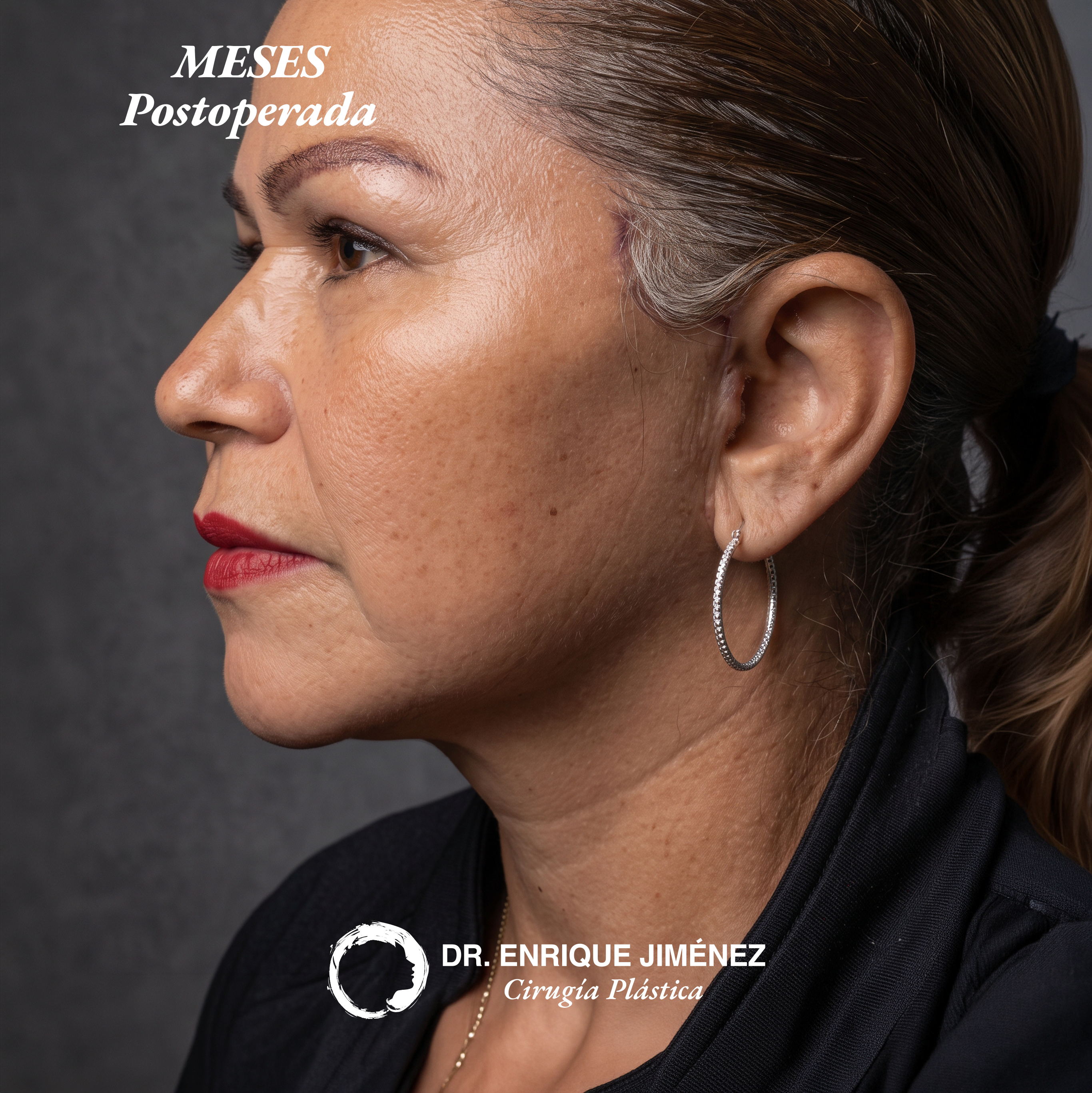Deep Facelift - Postoperada (vista de perfil)