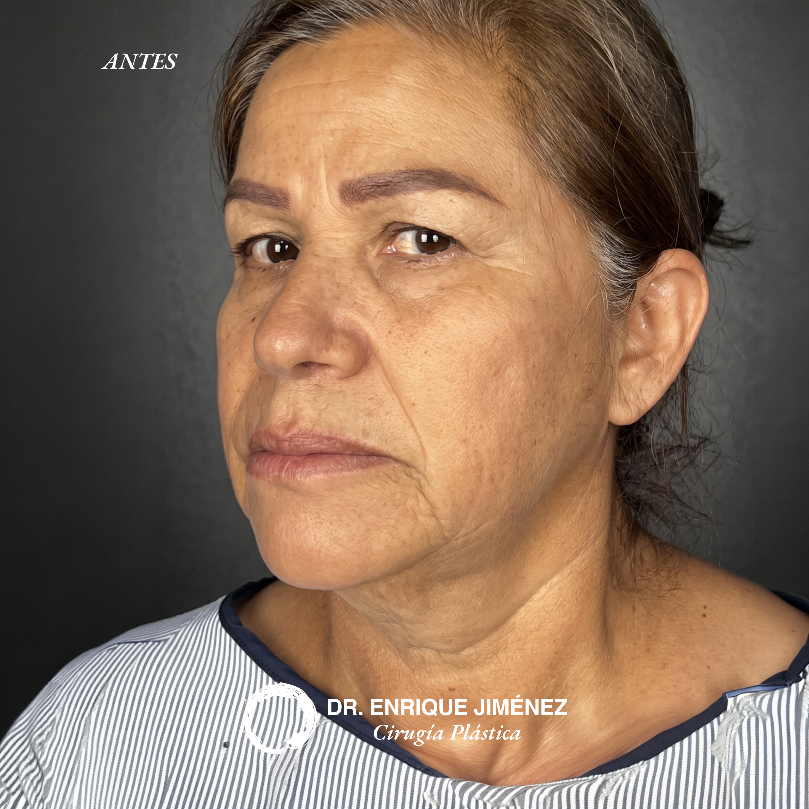 Deep Facelift - Antes (vista frontal)