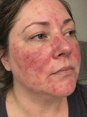 Amanda — Week 0, before using the serum
