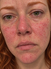 Bonnie — Week 0, before using the serum