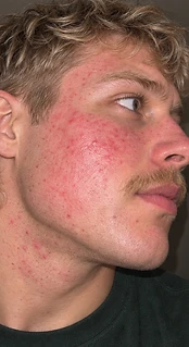 Ryan — Week 0, before using the serum