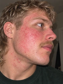 Ryan — Week 0, before using the serum