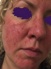 Sarah — Week 0, before using the serum
