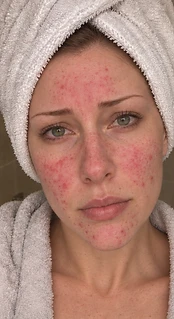 Rachel — Week 0, before using the serum