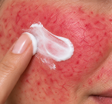 A single drop of the Rosacea Redness Neutralising Serum