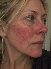 Imogen — Week 0, before using the serum