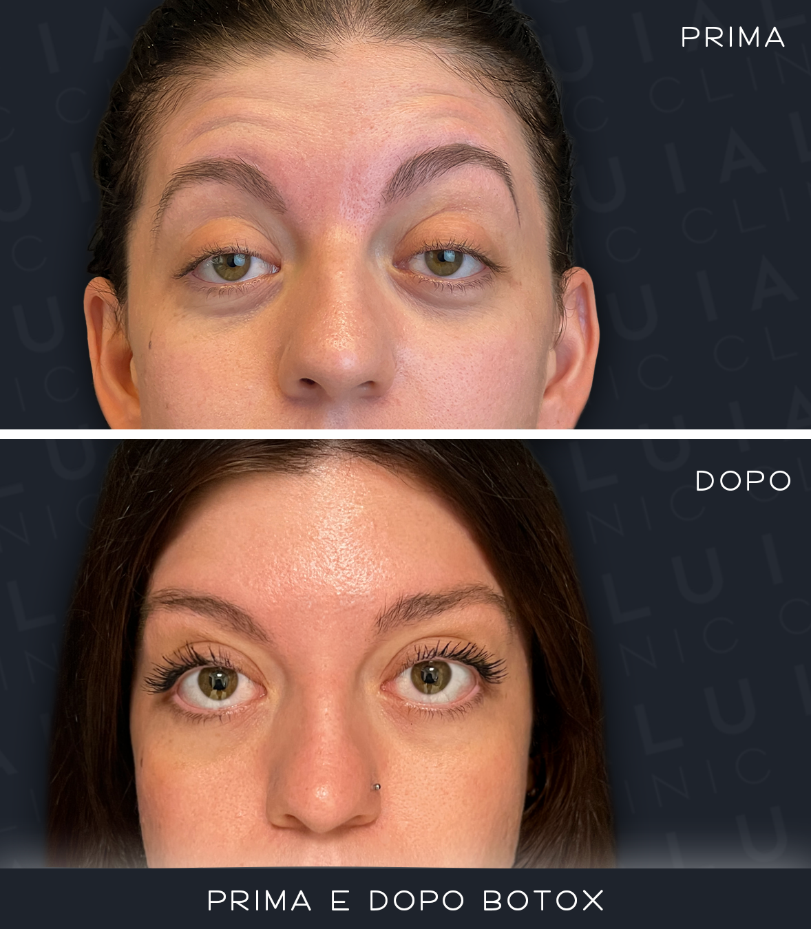Prima e Dopo Botox — volto intero