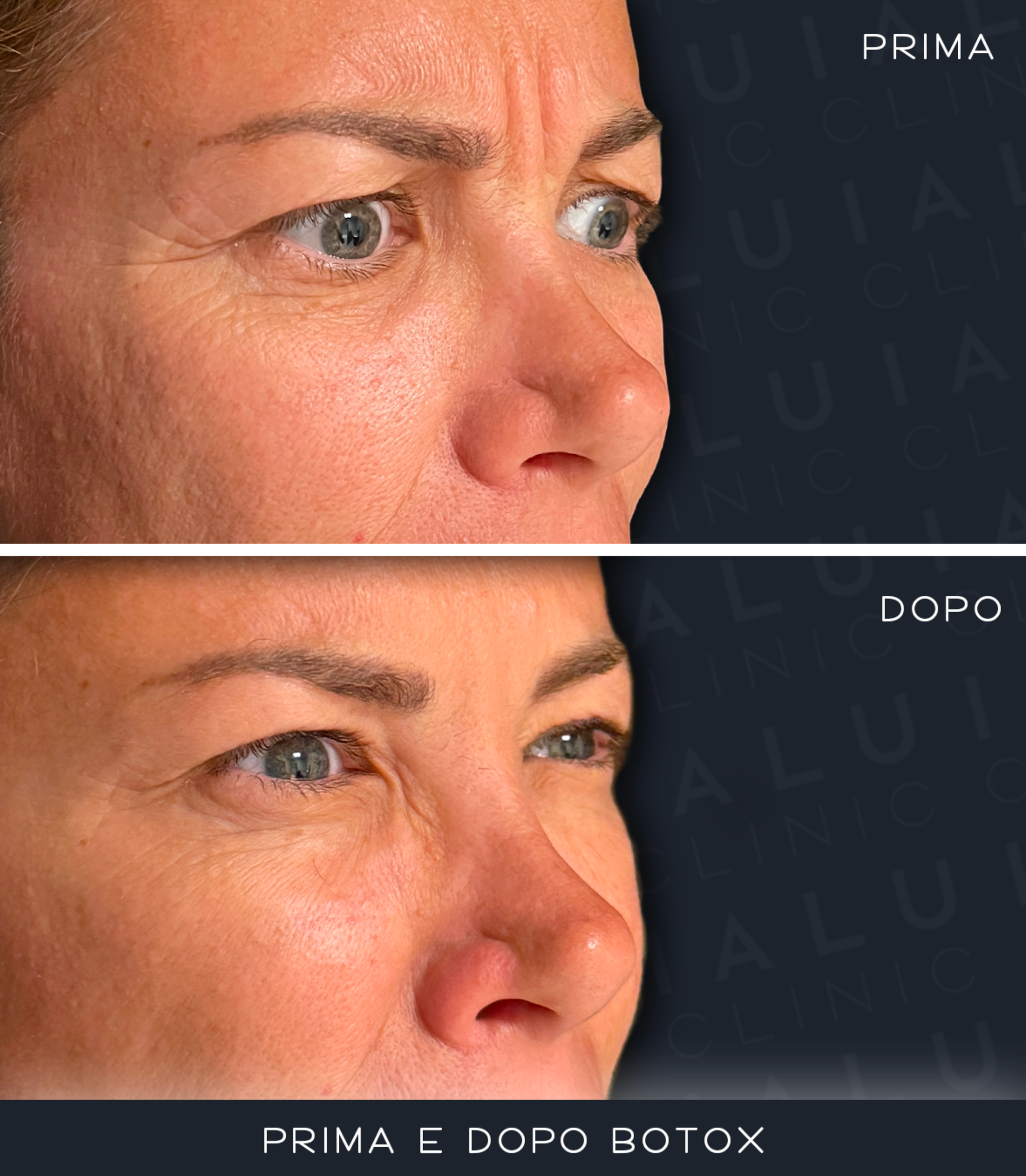 Prima e Dopo Botox — zona perioculare