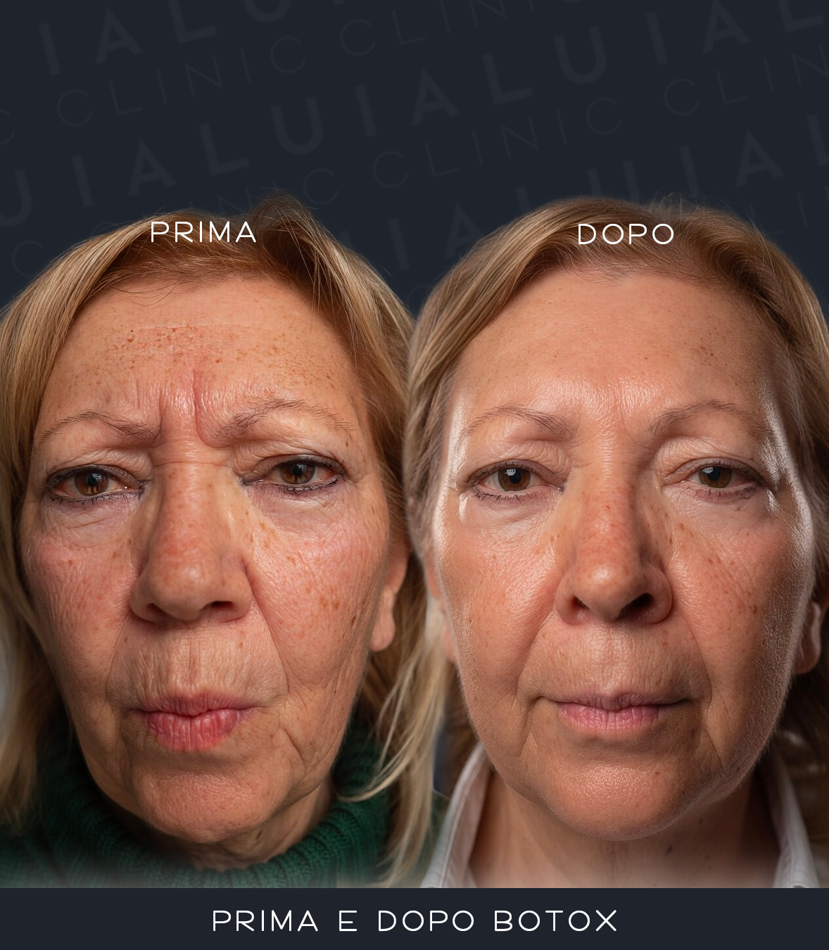 Prima e Dopo Botox — fronte e glabella