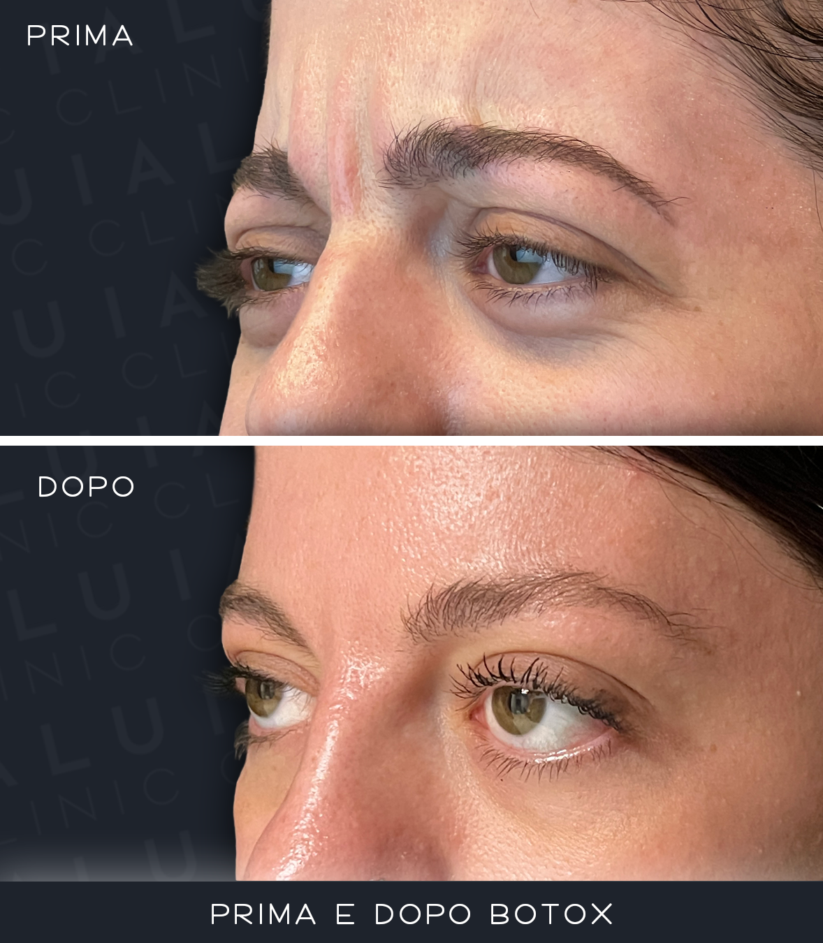 Prima e Dopo Botox — zona frontale