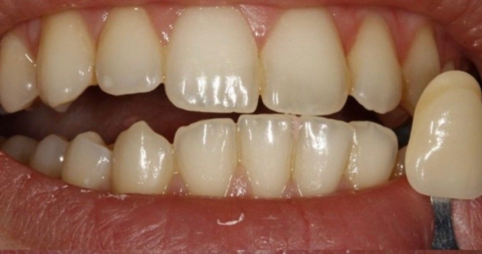 Teeth before whitening