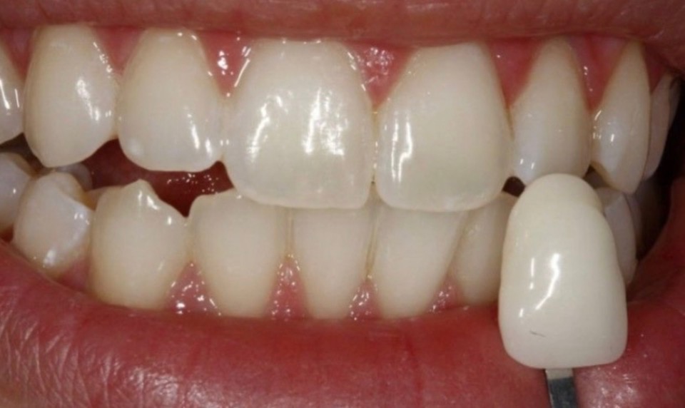 Teeth after whitening