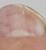 ToeFX phototherapy result 1 — after
