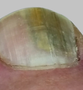 ToeFX phototherapy result 1 — before