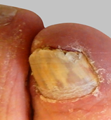 ToeFX phototherapy result 3 — before